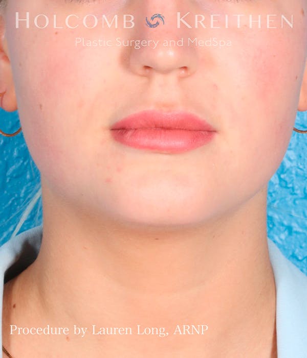 Fillers Before & After Gallery - Patient 113205552 - Image 1