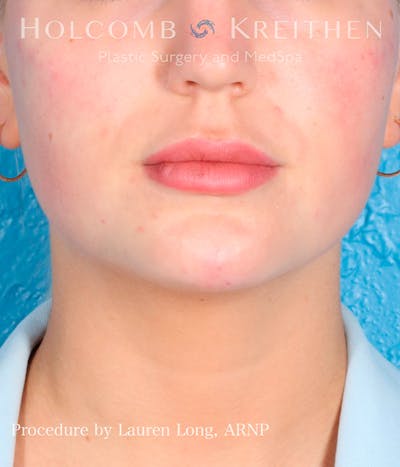 Fillers Before & After Gallery - Patient 113205552 - Image 2