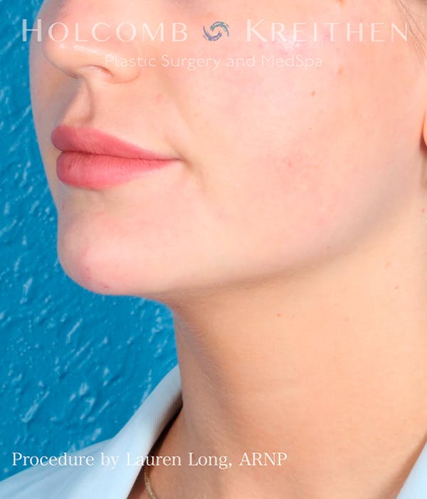 Fillers Before & After Gallery - Patient 113205552 - Image 4