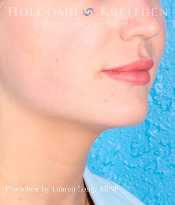 Fillers Before & After Gallery - Patient 113205552 - Image 5