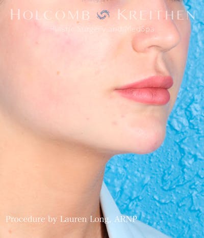 Fillers Before & After Gallery - Patient 113205552 - Image 6