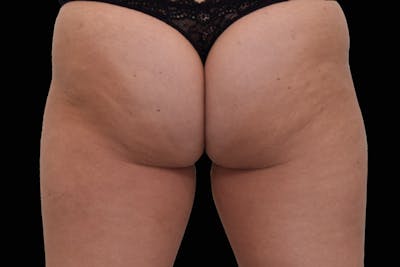 Emsculpt NEO Before & After Gallery - Patient 114868207 - Image 1