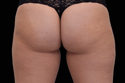 Emsculpt NEO Before & After Gallery - Patient 114868207 - Image 2