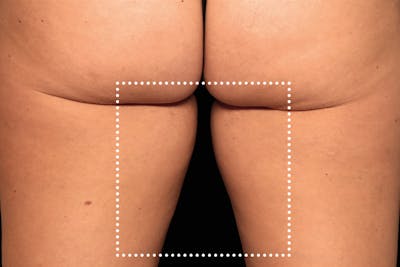 Emsculpt NEO Before & After Gallery - Patient 114868282 - Image 1