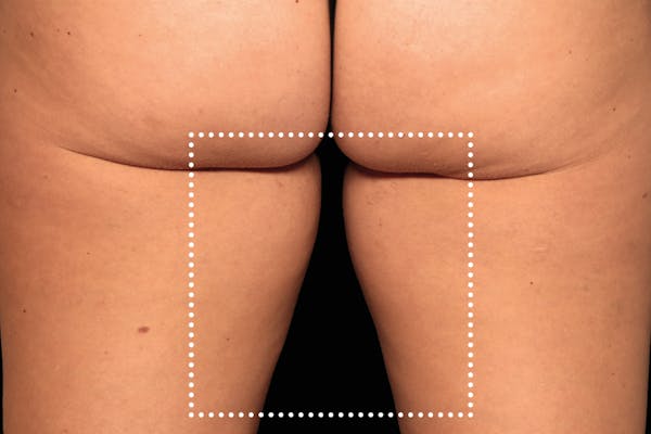 Emsculpt NEO Before & After Gallery - Patient 114868282 - Image 1