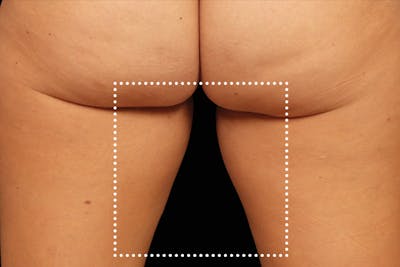 Emsculpt NEO Before & After Gallery - Patient 114868282 - Image 2