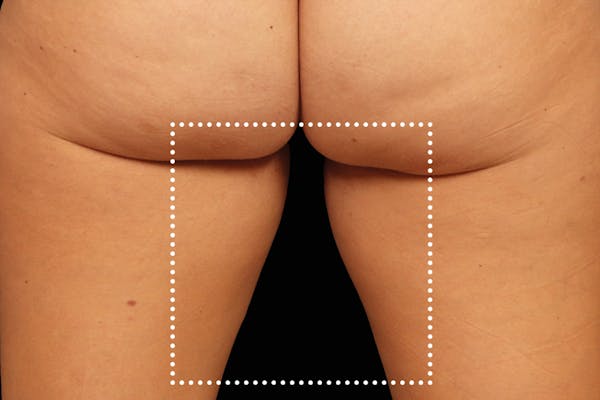 Emsculpt NEO Before & After Gallery - Patient 114868282 - Image 2