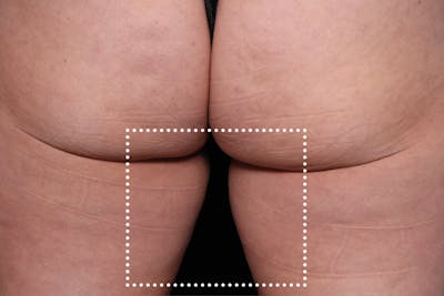 Emsculpt NEO Before & After Gallery - Patient 114868283 - Image 1