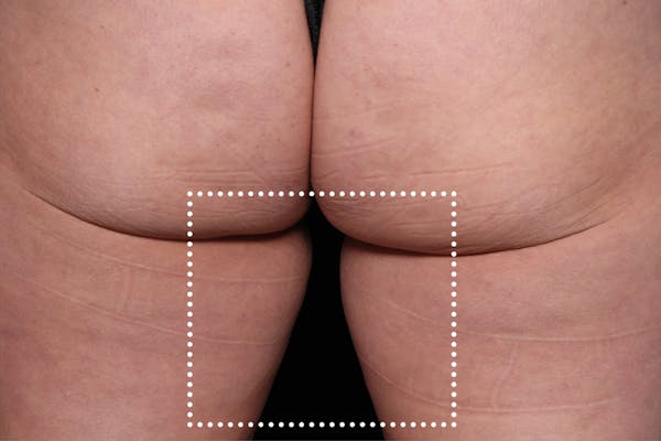 Emsculpt NEO Before & After Gallery - Patient 114868283 - Image 1