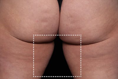 Emsculpt NEO Before & After Gallery - Patient 114868283 - Image 2