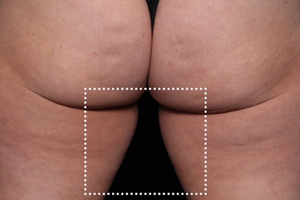 Emsculpt NEO Before & After Gallery - Patient 114868283 - Image 2