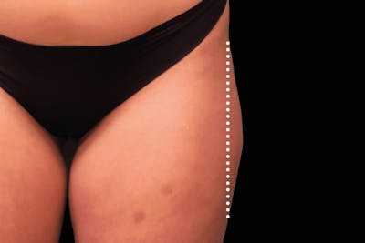 Emsculpt NEO Before & After Gallery - Patient 114868284 - Image 1