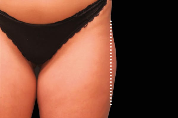 Emsculpt NEO Before & After Gallery - Patient 114868284 - Image 2