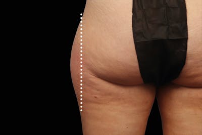 Emsculpt NEO Before & After Gallery - Patient 114868285 - Image 1