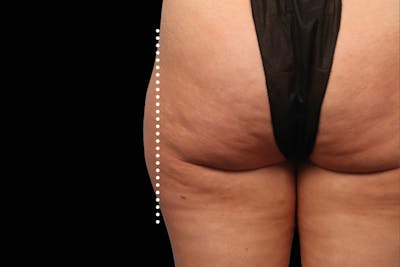 Emsculpt NEO Before & After Gallery - Patient 114868285 - Image 2