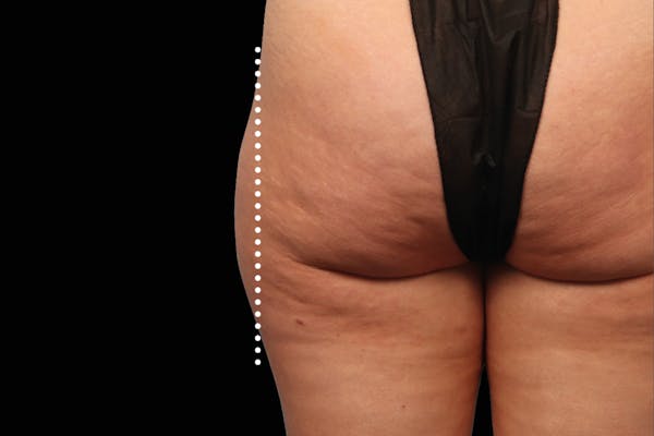Emsculpt NEO Before & After Gallery - Patient 114868285 - Image 2
