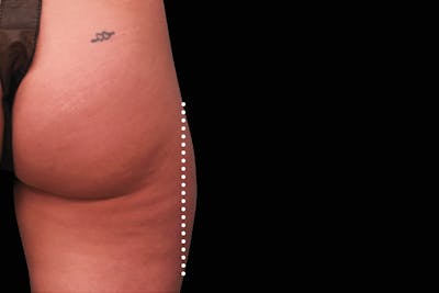 Emsculpt NEO Before & After Gallery - Patient 114868286 - Image 1