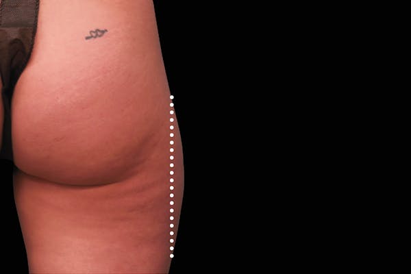 Emsculpt NEO Before & After Gallery - Patient 114868286 - Image 1