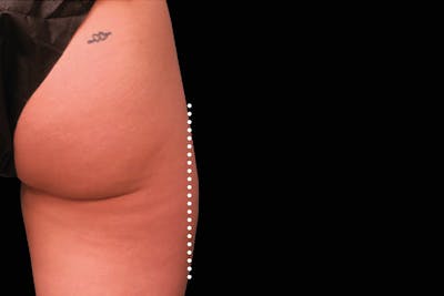 Emsculpt NEO Before & After Gallery - Patient 114868286 - Image 2
