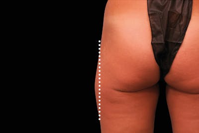 Emsculpt NEO Before & After Gallery - Patient 114868287 - Image 2