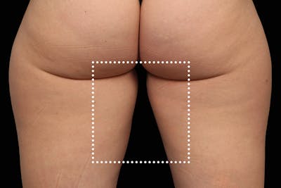 Emsculpt NEO Before & After Gallery - Patient 114868288 - Image 1