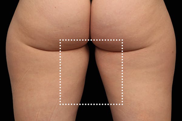 Emsculpt NEO Before & After Gallery - Patient 114868288 - Image 1
