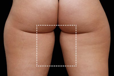 Emsculpt NEO Before & After Gallery - Patient 114868288 - Image 2