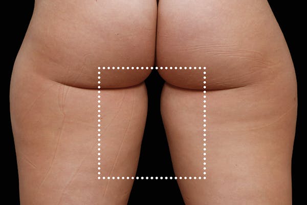 Emsculpt NEO Before & After Gallery - Patient 114868288 - Image 2
