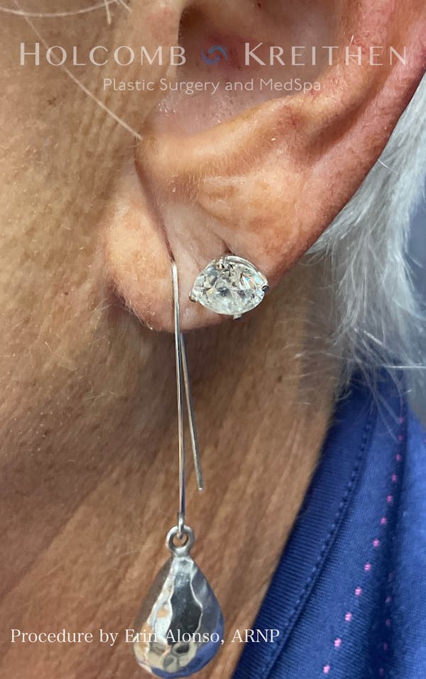 Fillers Before & After Gallery - Patient 120352650 - Image 1