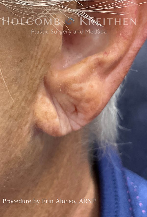 Fillers Before & After Gallery - Patient 120352650 - Image 3