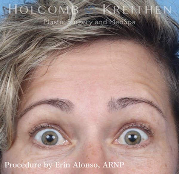 BOTOX Before & After Gallery - Patient 121198872 - Image 3