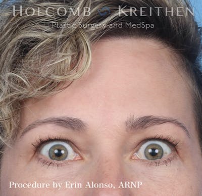 BOTOX Before & After Gallery - Patient 121198872 - Image 4