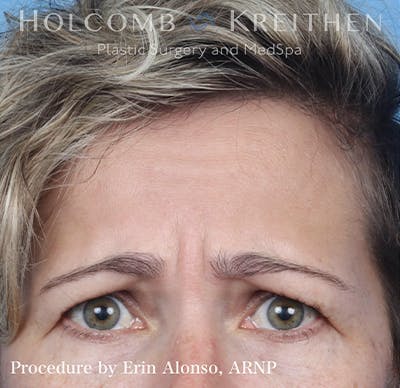 BOTOX Before & After Gallery - Patient 121198872 - Image 1