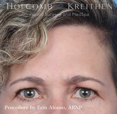 BOTOX Before & After Gallery - Patient 121198872 - Image 2