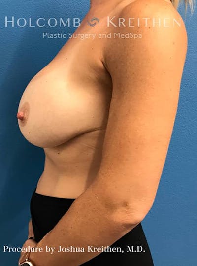 Breast Augmentation Before & After Gallery - Patient 121198966 - Image 10