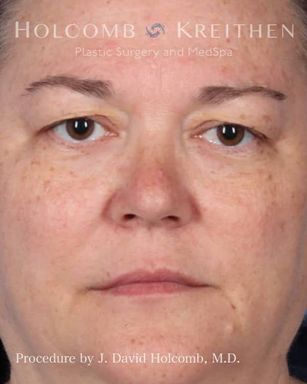 eCO2 Fractional Laser Before & After Gallery - Patient 121198977 - Image 1