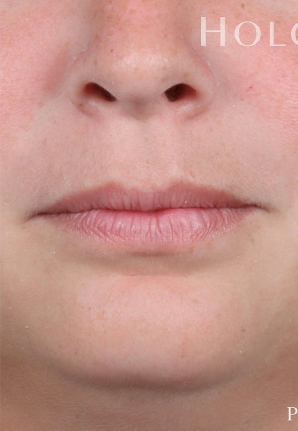Fillers Before & After Gallery - Patient 121198999 - Image 3