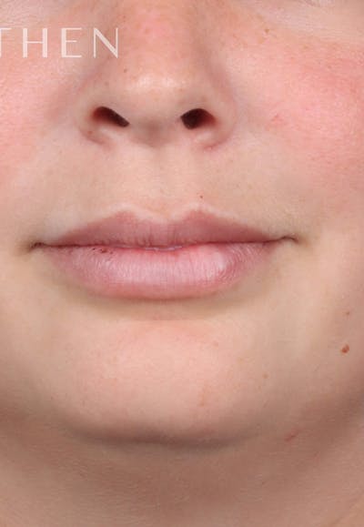 Fillers Before & After Gallery - Patient 121198999 - Image 4