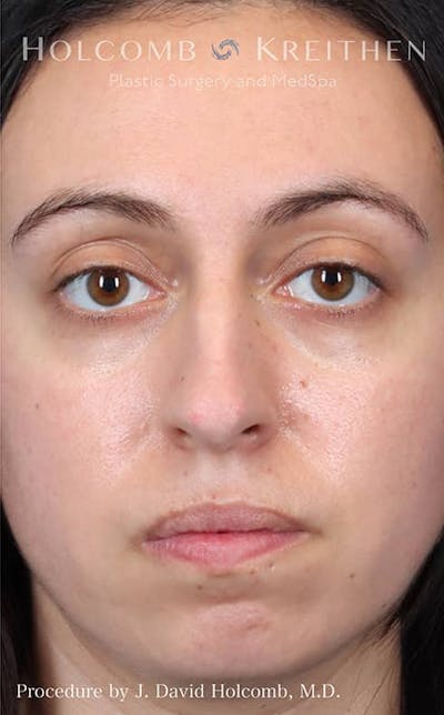 Rhinoplasty Before & After Gallery - Patient 121199050 - Image 1