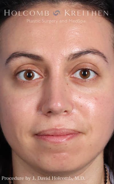 Rhinoplasty Before & After Gallery - Patient 121199050 - Image 2