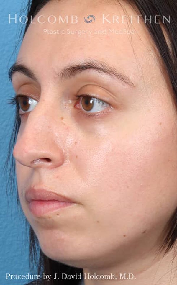 Rhinoplasty Before & After Gallery - Patient 121199050 - Image 3