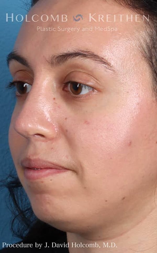 Rhinoplasty Before & After Gallery - Patient 121199050 - Image 4