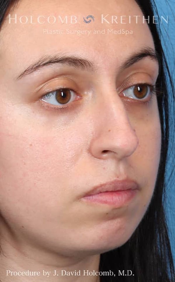 Rhinoplasty Before & After Gallery - Patient 121199050 - Image 5