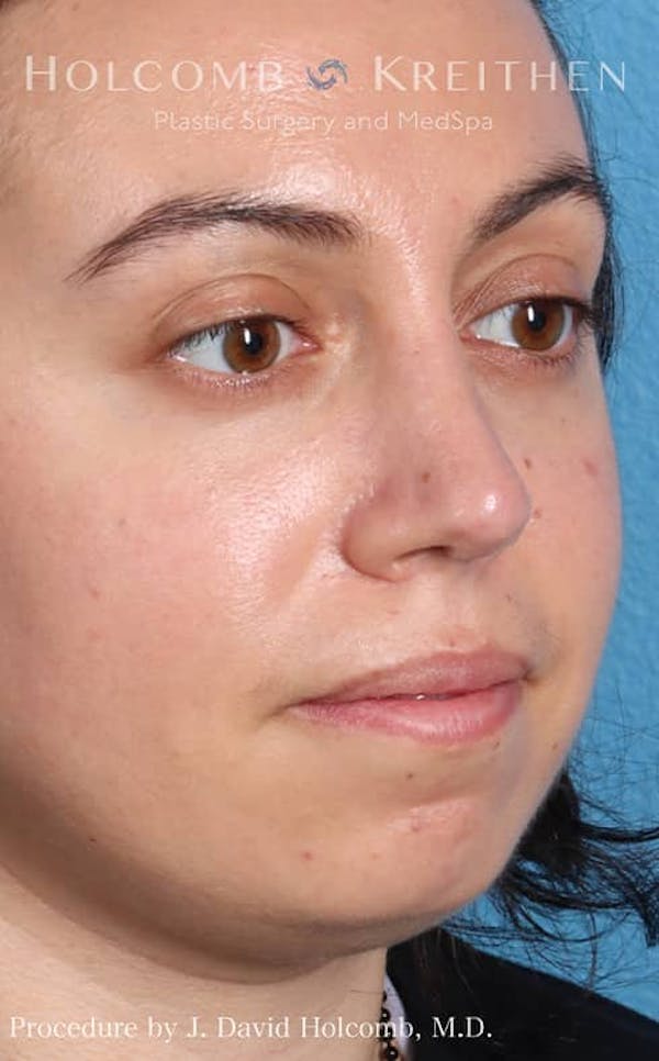 Rhinoplasty Before & After Gallery - Patient 121199050 - Image 6