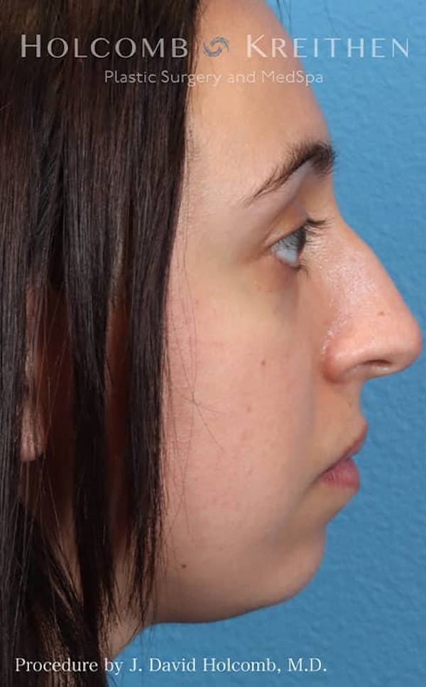 Rhinoplasty Before & After Gallery - Patient 121199050 - Image 7