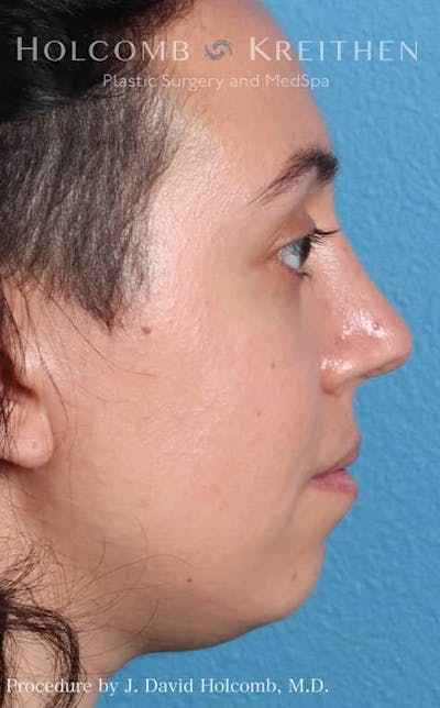 Rhinoplasty Before & After Gallery - Patient 121199050 - Image 8