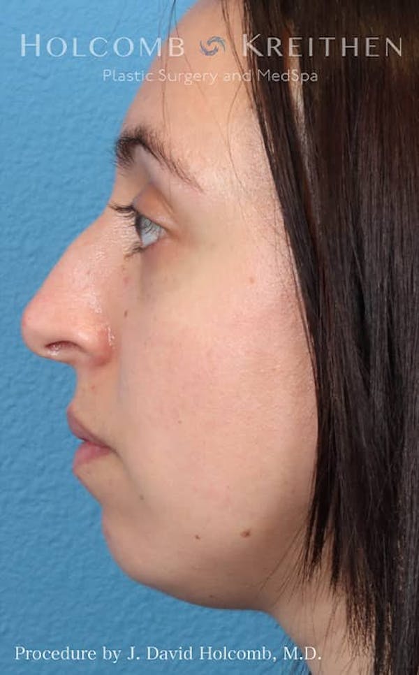 Rhinoplasty Before & After Gallery - Patient 121199050 - Image 9