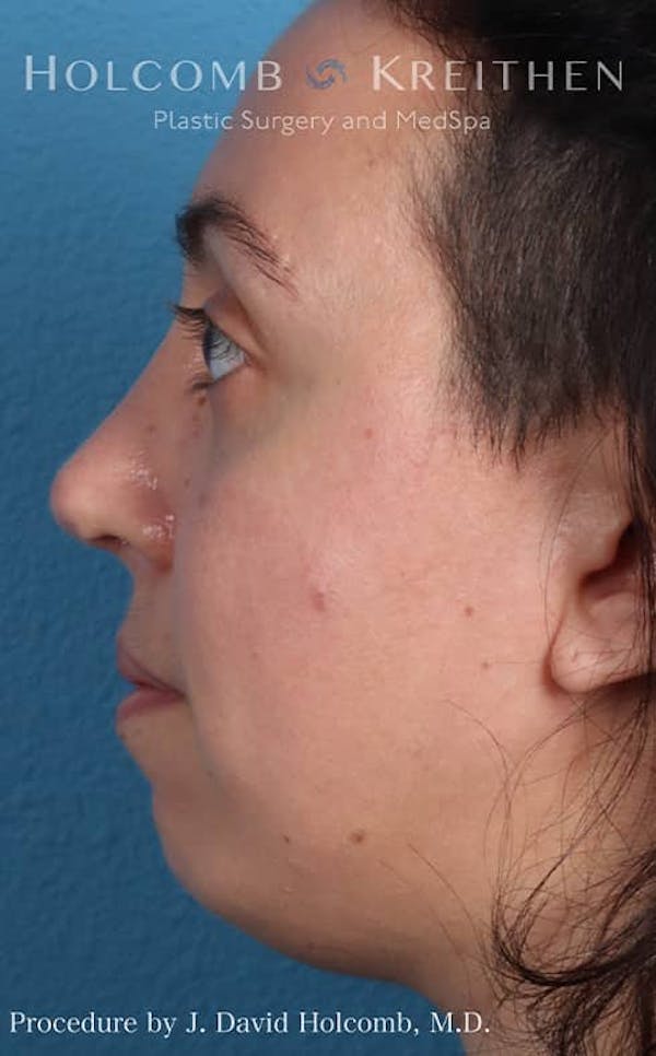 Rhinoplasty Before & After Gallery - Patient 121199050 - Image 10