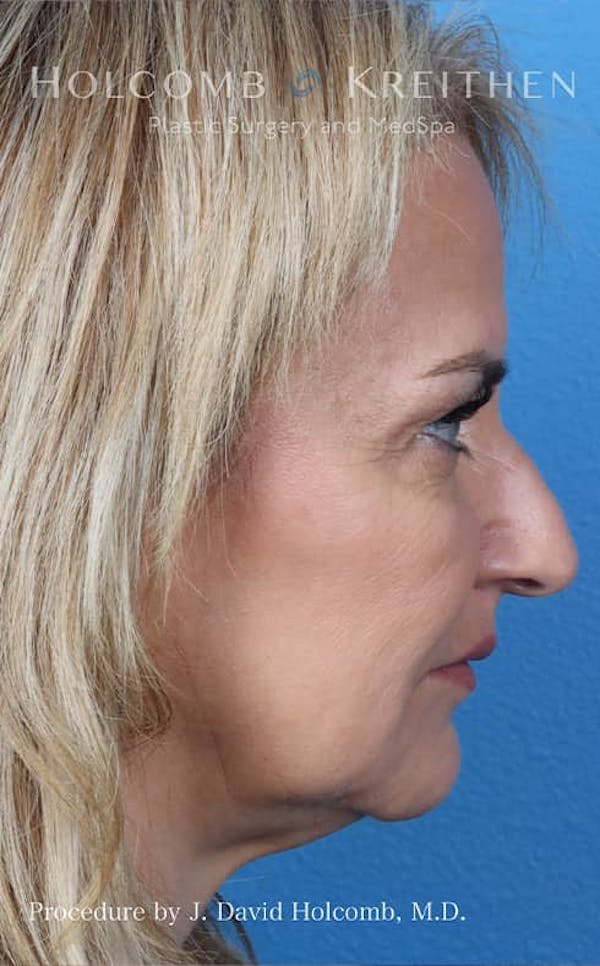 Rhinoplasty Before & After Gallery - Patient 121199066 - Image 5