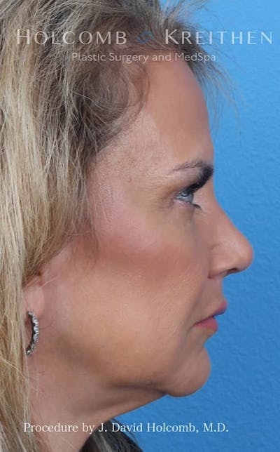 Rhinoplasty Before & After Gallery - Patient 121199066 - Image 6